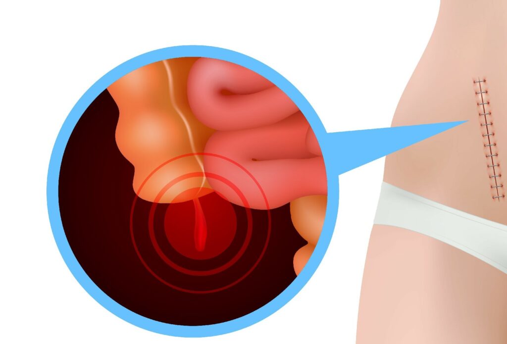 appendicitis treatment