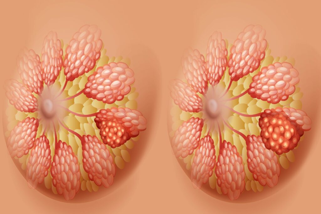 BREAST LUMP EXCISION