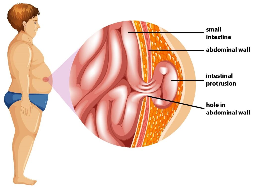 best hernia surgery in chennai