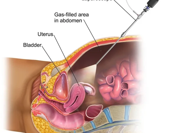 Understanding Laparoscopic Surgery: What “Keyhole Surgery” Actually Means