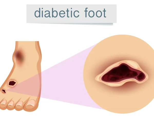 How to Prevent Diabetic Foot Complications: Practical Tips from Experts