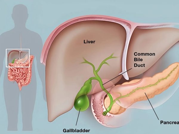 Gallbladder Stones: Symptoms, Causes, Diagnosis and Treatment