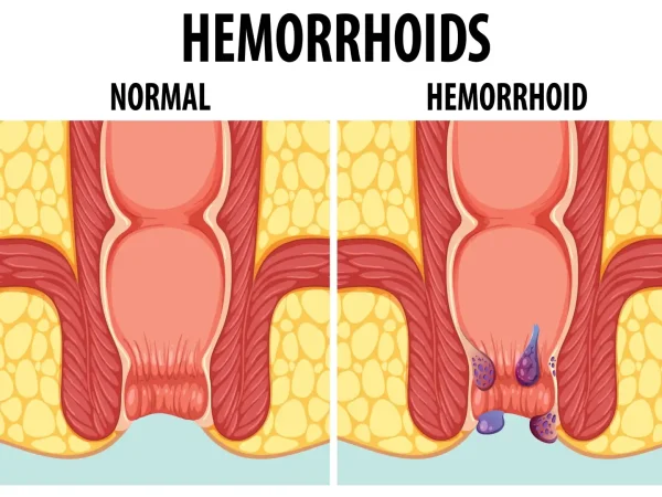 Fissure vs. Hemorrhoids: Understanding the Key Differences
