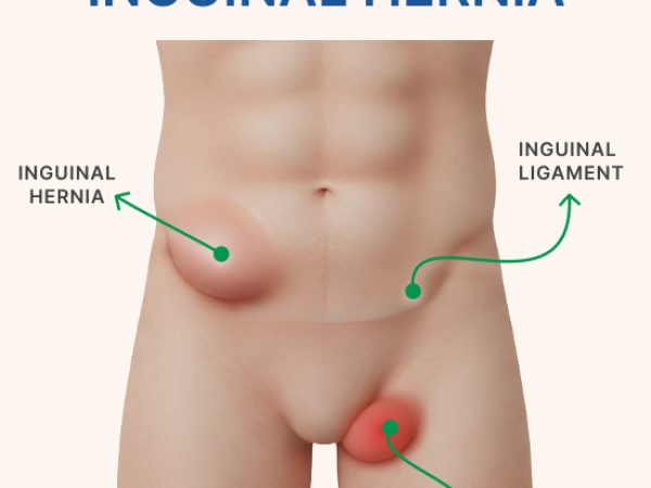 What Is Inguinal Hernia? Complete Guide to Symptoms, Diagnosis & Treatment