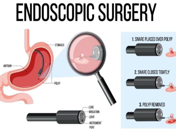 Endoscopy Explained: Procedure, Benefits, and Recovery