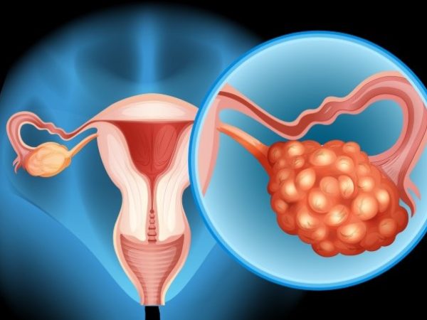 The Psychological Impact of Ovarian Cysts: Coping Strategies and Support Resources