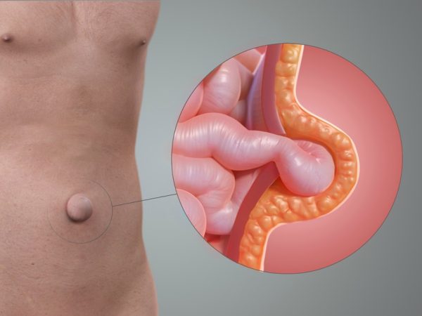 What Is Umbilical Hernia? Everything You Need to Know About Belly Button Hernias