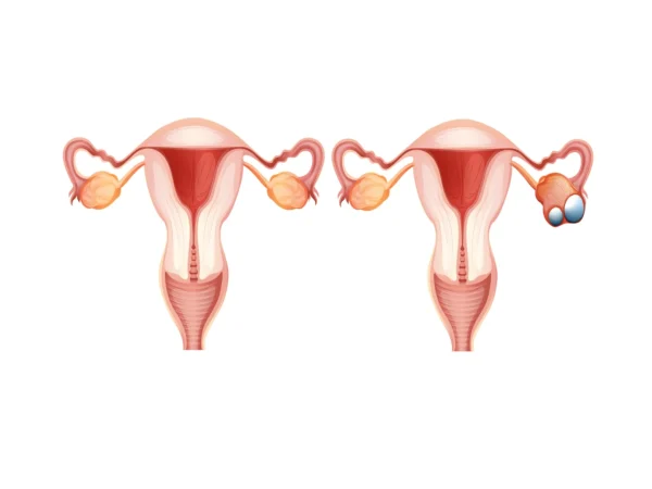 How Stress Affects Ovarian Cysts: Strategies for Stress Reduction