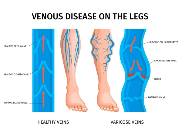 The Impact of Pregnancy on Varicose Veins: A Guide for Expecting Mothers