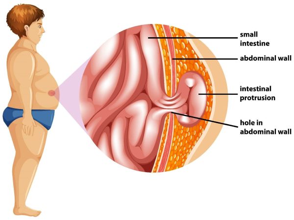 Everything You Want to Know About Hernias