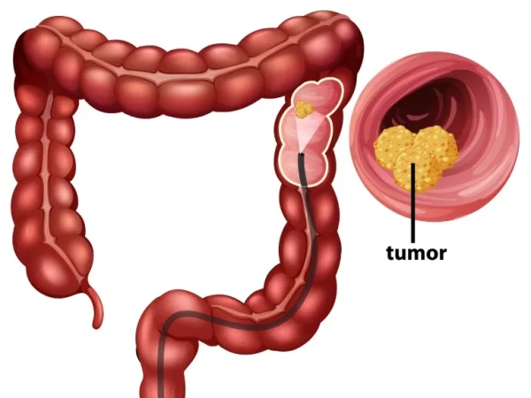 Ulcerative Colitis Research and Innovation: Promising Developments in Treatment
