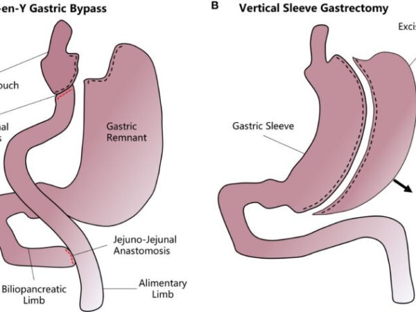 Gastric Bypass vs Sleeve Gastrectomy: Key Differences Explain