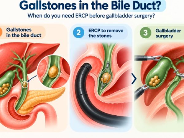 Gallstones in the Bile Duct: When Do You Need ERCP Before Gallbladder Surgery?