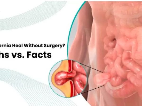 Can Hernias Heal Without Surgery? Separating Myths from Facts