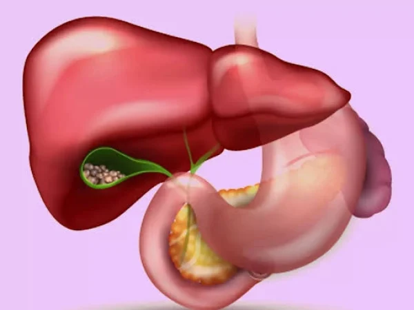 Gallstones in Children and Teenagers: Symptoms, Treatment Options, and When Surgery Is Necessary
