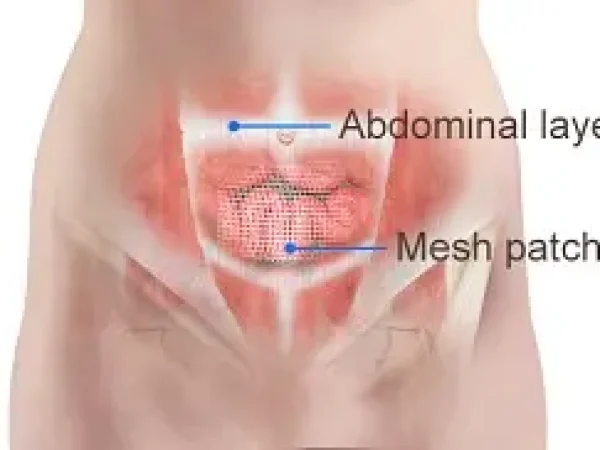 What Is an Incisional Hernia? Understanding Post-Surgical Hernias and Treatment Options