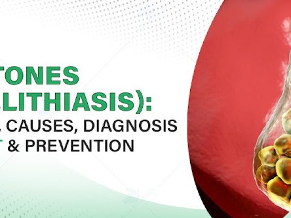 Silent Gallstones vs. Active Attacks: When Can You Wait, and When Is It an Emergency?