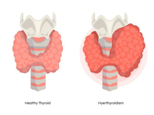 How to manage Hypothyroidism: The Crucial Role of Diet