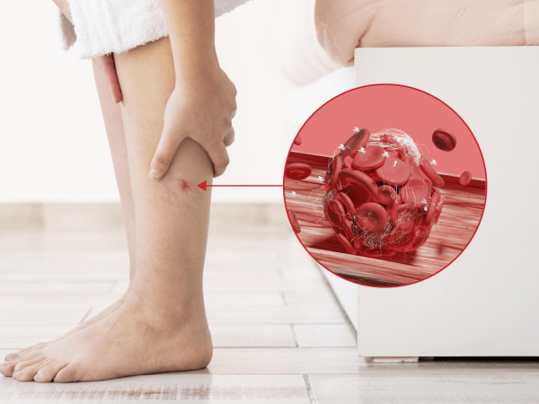 Weather Conditions Affect Varicose Veins?