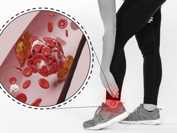 Is Walking Beneficial for Varicose Veins?